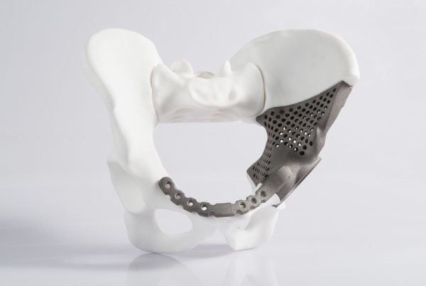 3d-printed metal pelvic implant model in white and gray, demonstrating medical technology for bone replacement.